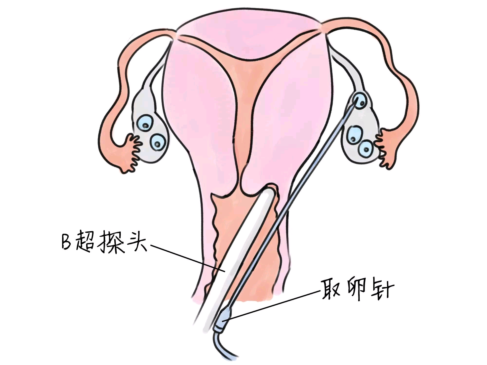 小產(chǎn)假