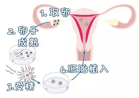 試管嬰兒技術(shù)