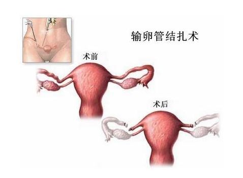 女性不排卵