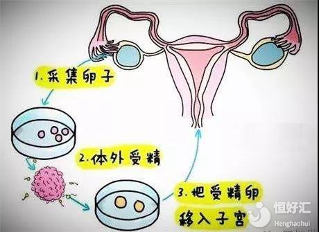 取卵
